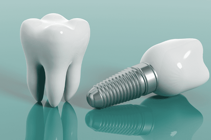 Diş implant tedavi süreci görseli